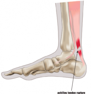 achilles tendon