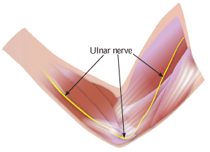 Ulnar nerve entrapment, also known as cubital tunnel syndrome, can