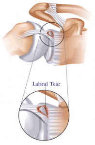 Shoulder_Labral_Tear2