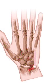 Triangular Fibrocartilage Complex