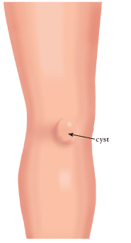 Baker's Cysts | Grand Central Physical Therapy and Hand Therapy, New