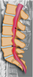 spinalstenosis